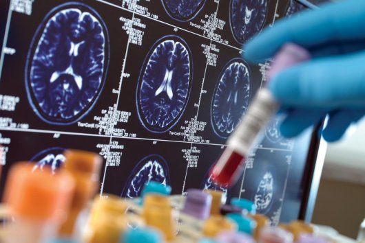 Gargamelizácia klinického výskumu demencie